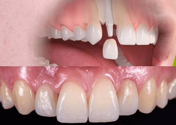 Cirkoniniai dantų implantai – norintiems turėti estetišką šypseną